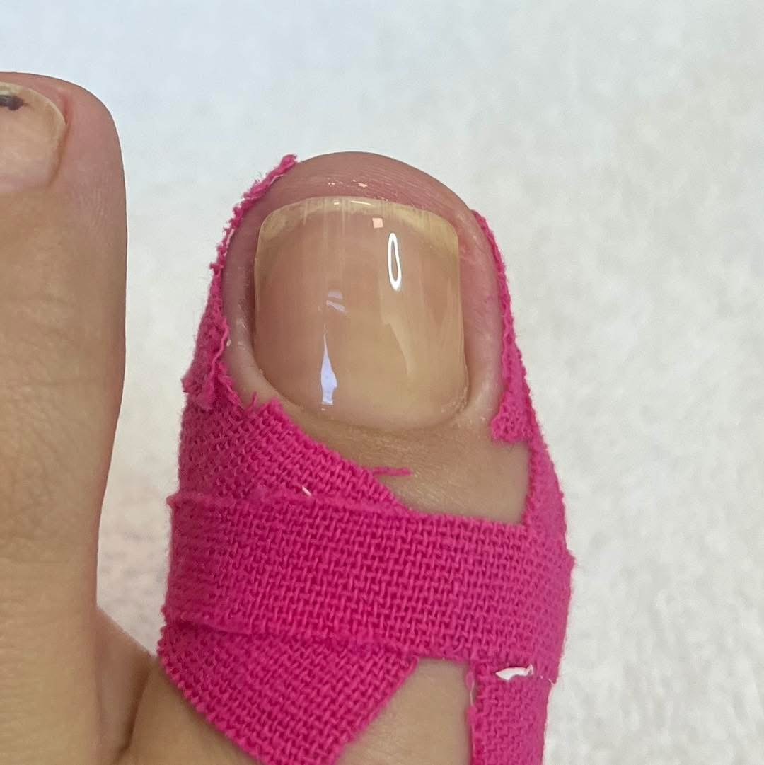 Vraščen noht in Lift Up Gel terapija - strokovna obravnava